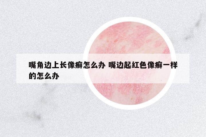 嘴角邊上長(zhǎng)像癬怎么辦 嘴邊起紅色像癬一樣的怎么辦