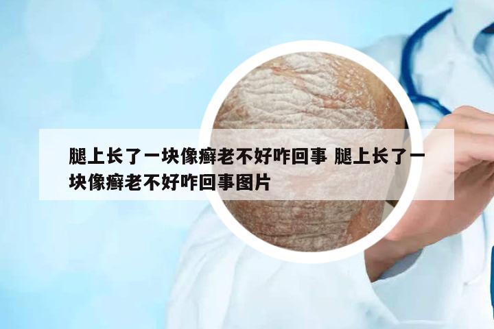 腿上長了一塊像癬老不好咋回事 腿上長了一塊像癬老不好咋回事圖片