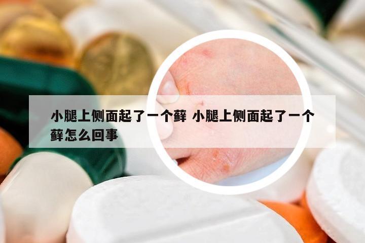 小腿上側(cè)面起了一個蘚 小腿上側(cè)面起了一個蘚怎么回事