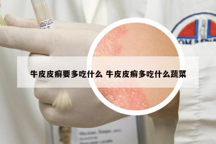 牛皮皮癬要多吃什么 牛皮皮癬多吃什么蔬菜