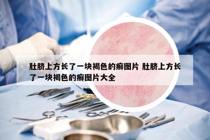 肚臍上方長了一塊褐色的癬圖片 肚臍上方長了一塊褐色的癬圖片大全