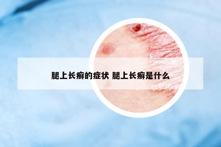 腿上長(zhǎng)癬的癥狀 腿上長(zhǎng)癬是什么