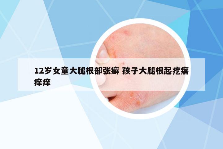 12歲女童大腿根部張癬 孩子大腿根起疙瘩癢癢