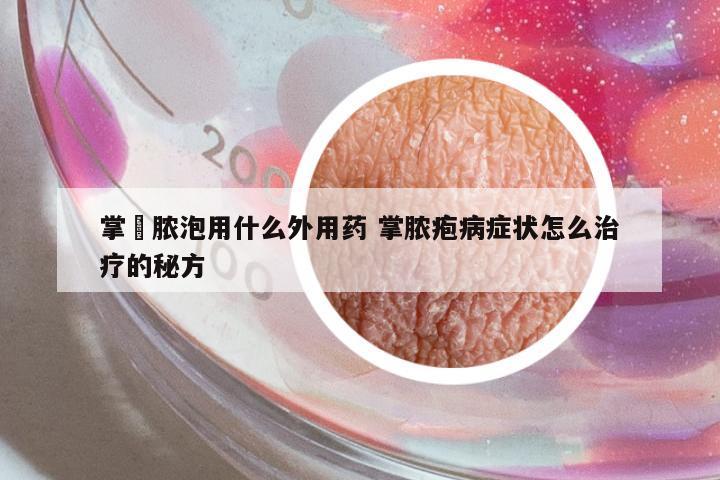 掌砋膿泡用什么外用藥 掌膿皰病癥狀怎么治療的秘方