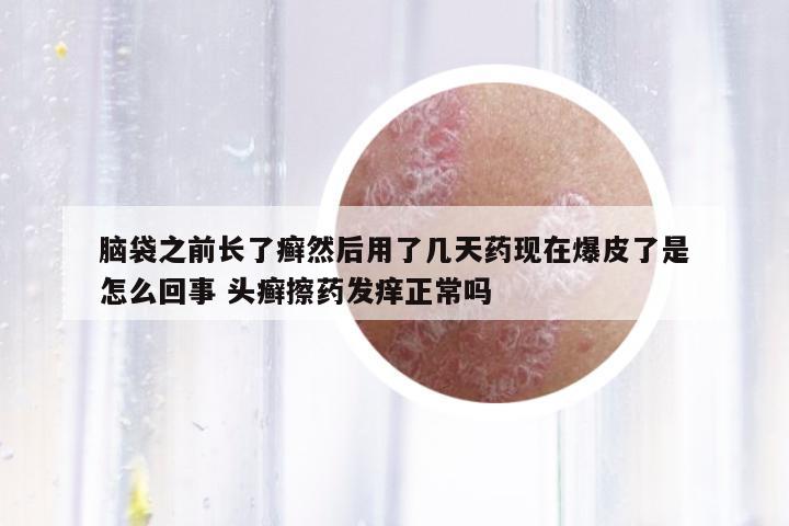 腦袋之前長了癬然后用了幾天藥現(xiàn)在爆皮了是怎么回事 頭癬擦藥發(fā)癢正常嗎