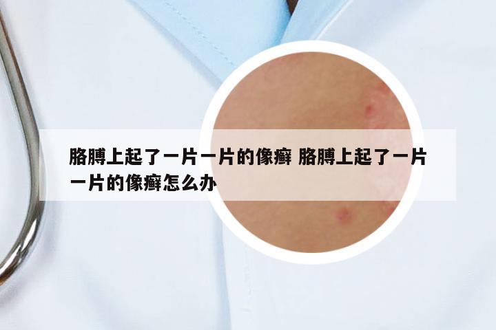 胳膊上起了一片一片的像癬 胳膊上起了一片一片的像癬怎么辦