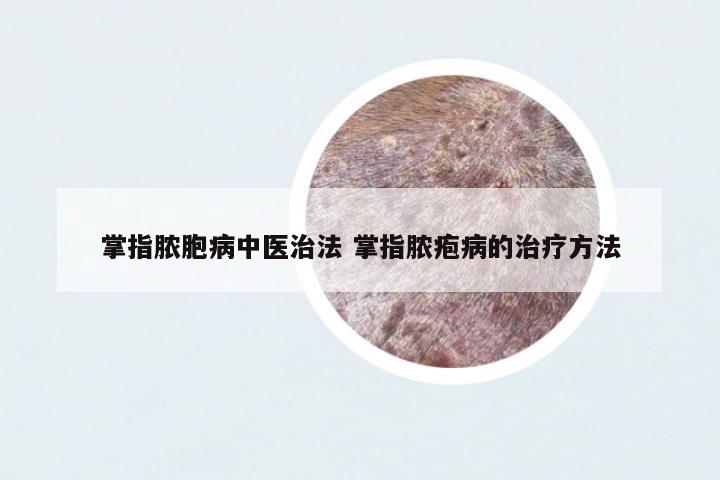 掌指膿胞病中醫(yī)治法 掌指膿皰病的治療方法