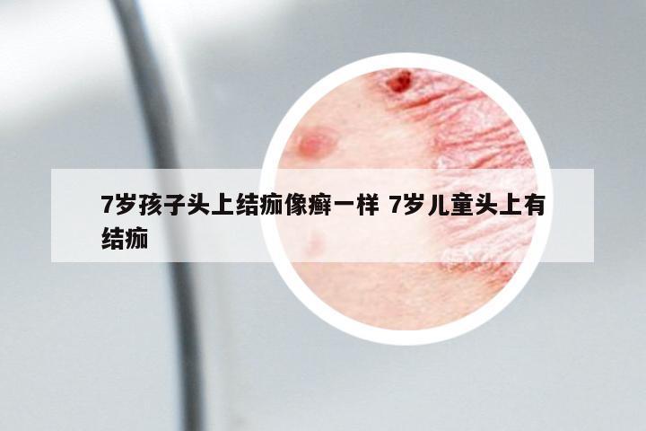 7歲孩子頭上結(jié)痂像癬一樣 7歲兒童頭上有結(jié)痂