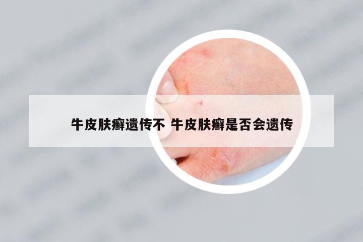 牛皮膚癬遺傳不 牛皮膚癬是否會(huì)遺傳