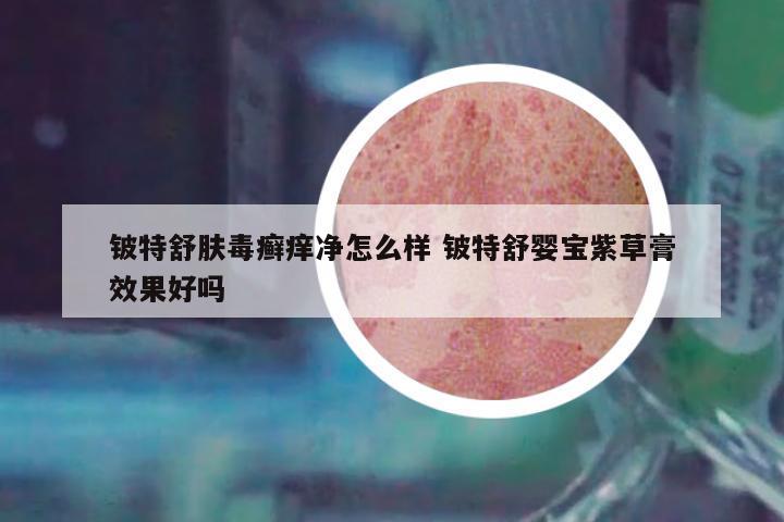 鈹特舒膚毒癬癢凈怎么樣 鈹特舒嬰寶紫草膏效果好嗎