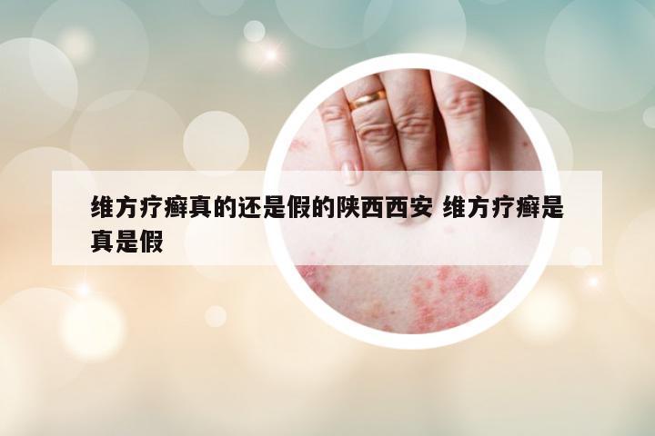 維方療癬真的還是假的陜西西安 維方療癬是真是假