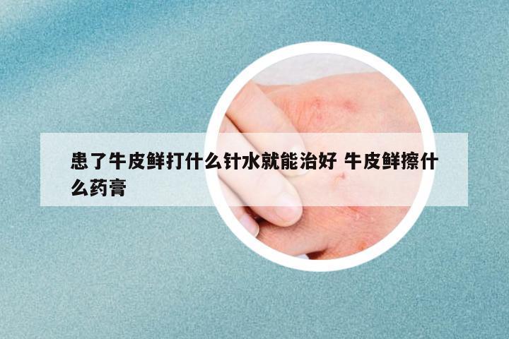 患了牛皮鮮打什么針水就能治好 牛皮鮮擦什么藥膏
