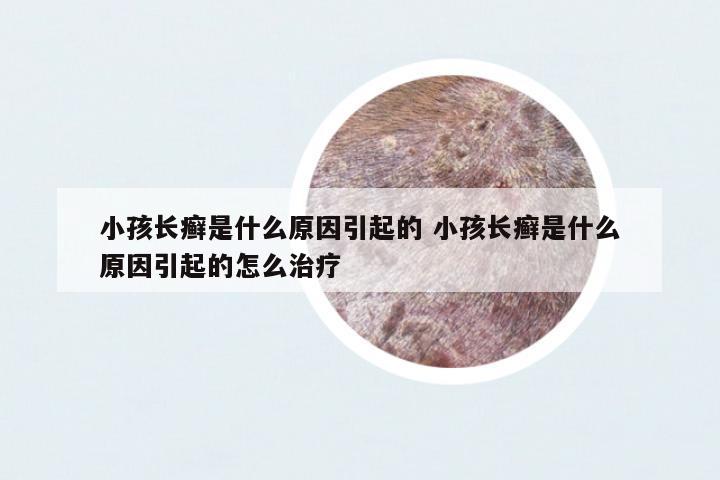 小孩長癬是什么原因引起的 小孩長癬是什么原因引起的怎么治療
