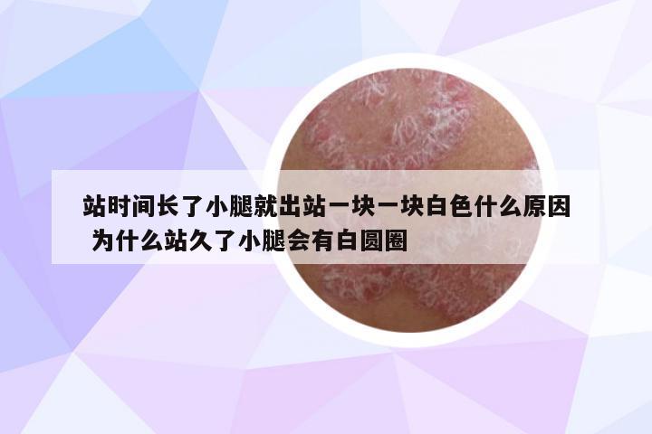 站時(shí)間長(zhǎng)了小腿就出站一塊一塊白色什么原因 為什么站久了小腿會(huì)有白圓圈