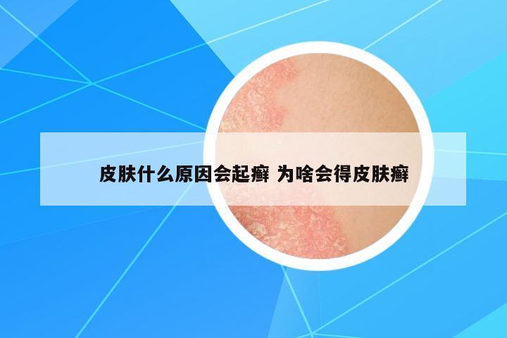 皮膚什么原因會起癬 為啥會得皮膚癬