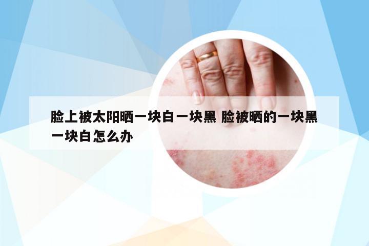 臉上被太陽曬一塊白一塊黑 臉被曬的一塊黑一塊白怎么辦