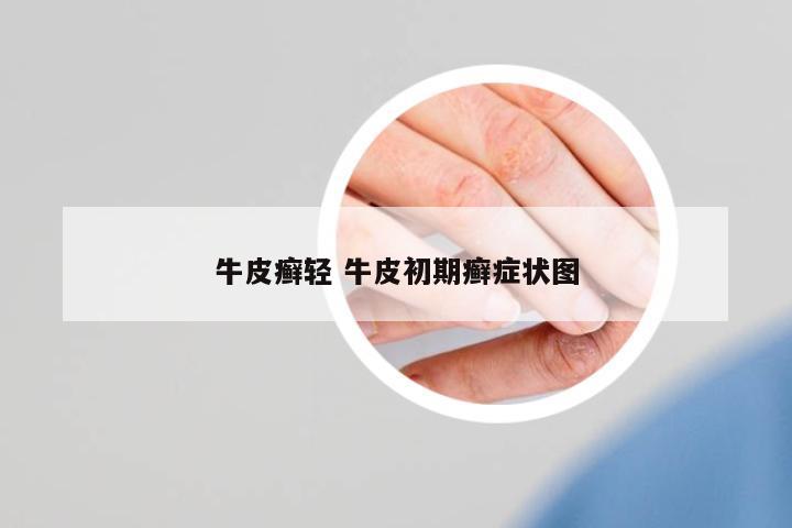 牛皮癬輕 牛皮初期癬癥狀圖