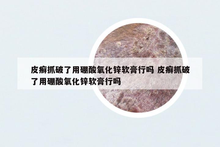 皮癬抓破了用硼酸氧化鋅軟膏行嗎 皮癬抓破了用硼酸氧化鋅軟膏行嗎