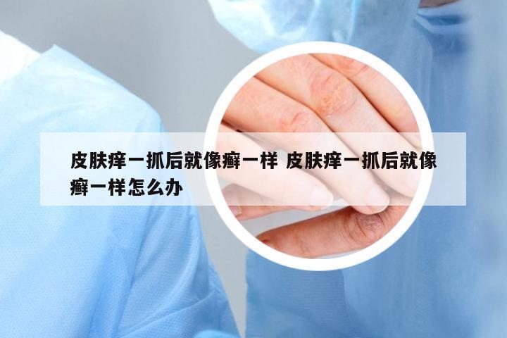 皮膚癢一抓后就像癬一樣 皮膚癢一抓后就像癬一樣怎么辦