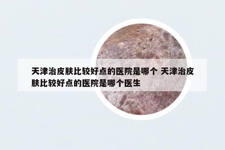 天津治皮膚比較好點(diǎn)的醫(yī)院是哪個(gè) 天津治皮膚比較好點(diǎn)的醫(yī)院是哪個(gè)醫(yī)生