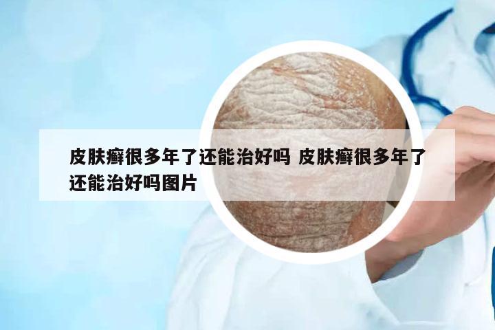 皮膚癬很多年了還能治好嗎 皮膚癬很多年了還能治好嗎圖片