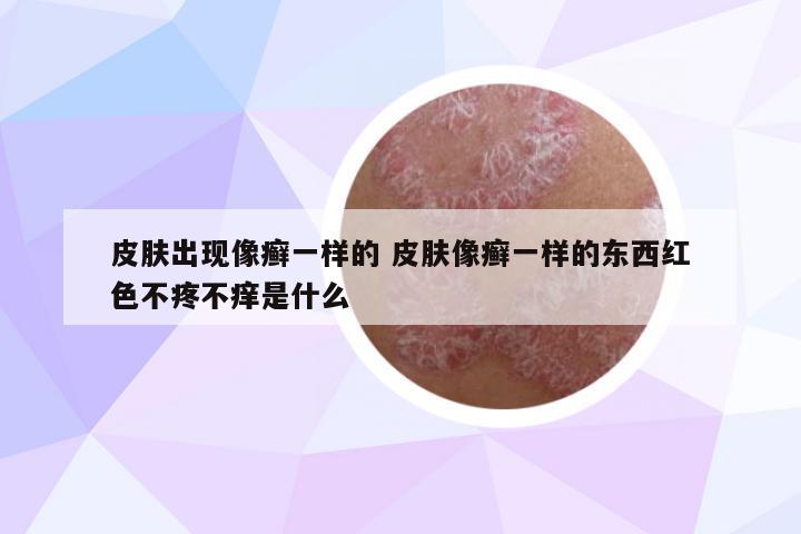 皮膚出現(xiàn)像癬一樣的 皮膚像癬一樣的東西紅色不疼不癢是什么