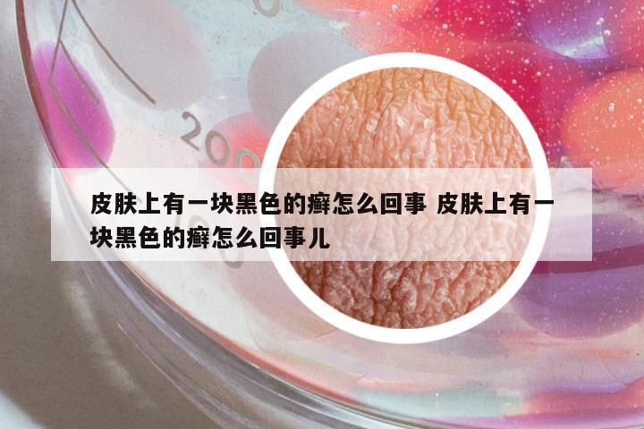 皮膚上有一塊黑色的癬怎么回事 皮膚上有一塊黑色的癬怎么回事兒