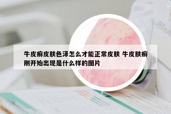 牛皮癬皮膚色澤怎么才能正常皮膚 牛皮膚癬剛開始出現(xiàn)是什么樣的圖片