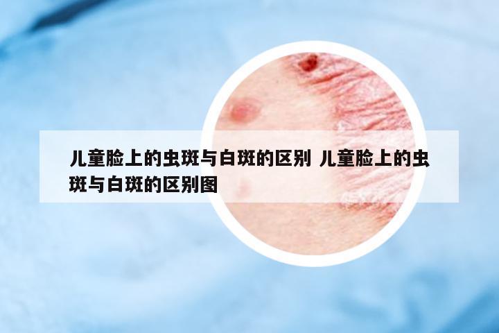 兒童臉上的蟲斑與白斑的區(qū)別 兒童臉上的蟲斑與白斑的區(qū)別圖