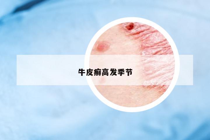 牛皮癬高發(fā)季節(jié)