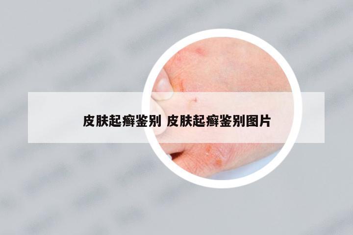 皮膚起癬鑒別 皮膚起癬鑒別圖片