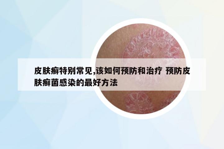 皮膚癬特別常見,該如何預防和治療 預防皮膚癬菌感染的最好方法