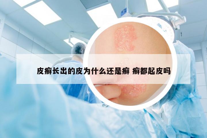 皮癬長出的皮為什么還是癬 癬都起皮嗎