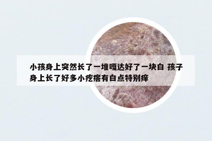 小孩身上突然長(zhǎng)了一堆嘎達(dá)好了一塊白 孩子身上長(zhǎng)了好多小疙瘩有白點(diǎn)特別癢