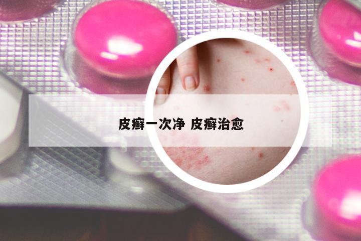 皮癬一次凈 皮癬治愈