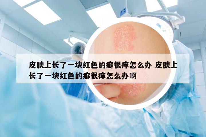 皮膚上長了一塊紅色的癬很癢怎么辦 皮膚上長了一塊紅色的癬很癢怎么辦啊