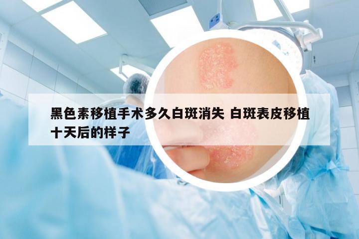 黑色素移植手術(shù)多久白斑消失 白斑表皮移植十天后的樣子