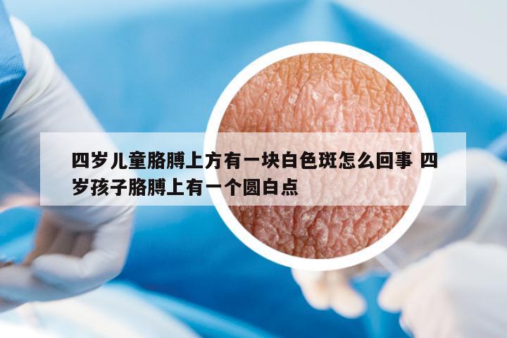 四歲兒童胳膊上方有一塊白色斑怎么回事 四歲孩子胳膊上有一個圓白點(diǎn)