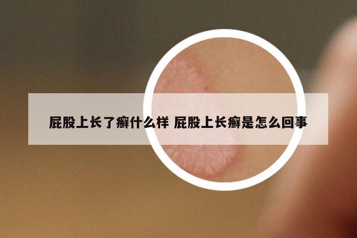屁股上長(zhǎng)了癬什么樣 屁股上長(zhǎng)癬是怎么回事