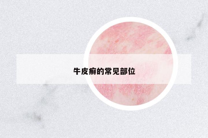 牛皮癬的常見部位