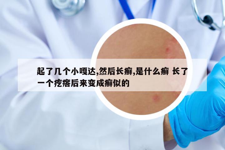 起了幾個小嘎達(dá),然后長癬,是什么癬 長了一個疙瘩后來變成癬似的