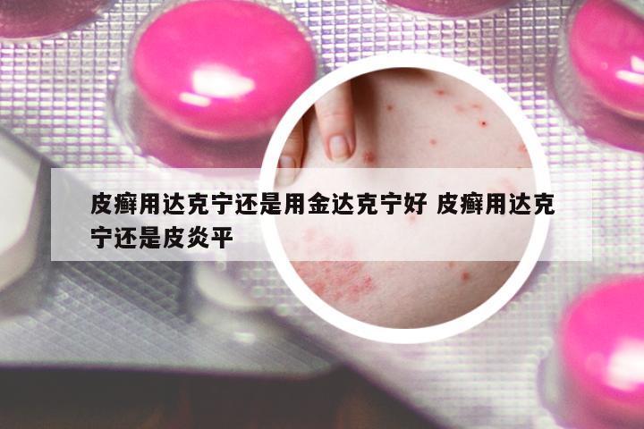 皮癬用達(dá)克寧還是用金達(dá)克寧好 皮癬用達(dá)克寧還是皮炎平