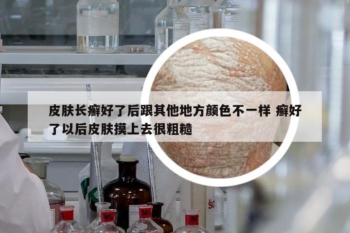 皮膚長癬好了后跟其他地方顏色不一樣 癬好了以后皮膚摸上去很粗糙