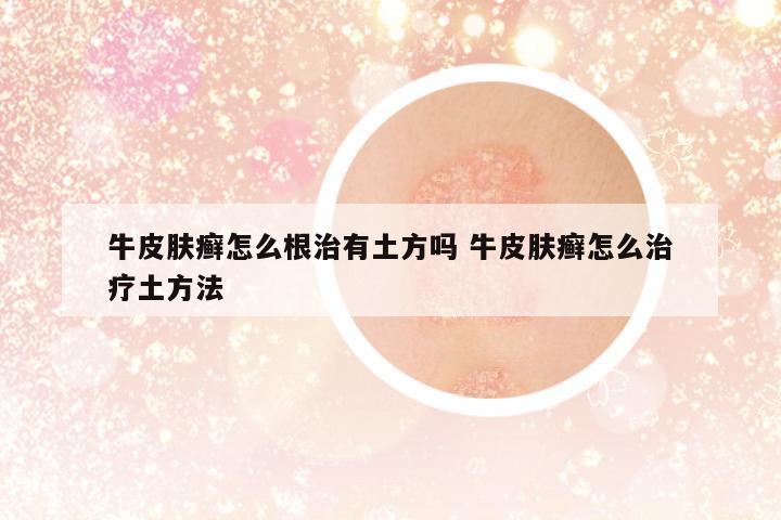 牛皮膚癬怎么根治有土方嗎 牛皮膚癬怎么治療土方法