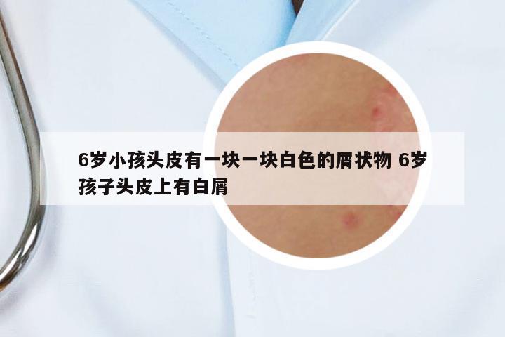 6歲小孩頭皮有一塊一塊白色的屑狀物 6歲孩子頭皮上有白屑
