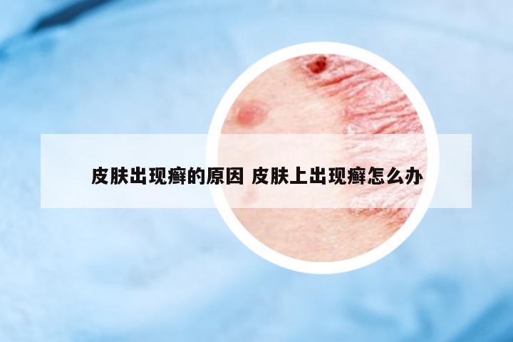 皮膚出現(xiàn)癬的原因 皮膚上出現(xiàn)癬怎么辦