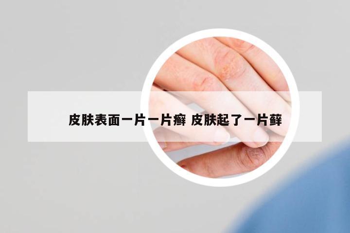 皮膚表面一片一片癬 皮膚起了一片蘚