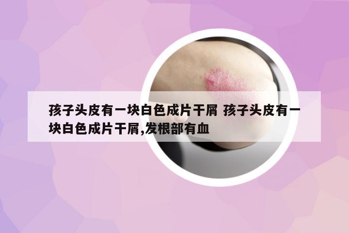 孩子頭皮有一塊白色成片干屑 孩子頭皮有一塊白色成片干屑,發(fā)根部有血