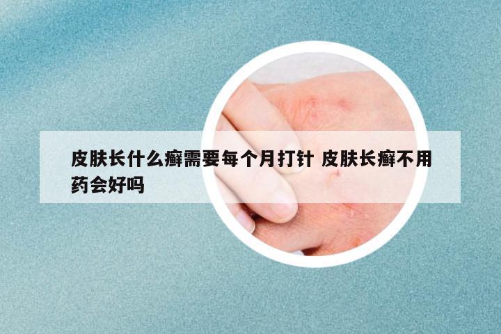 皮膚長什么癬需要每個月打針 皮膚長癬不用藥會好嗎