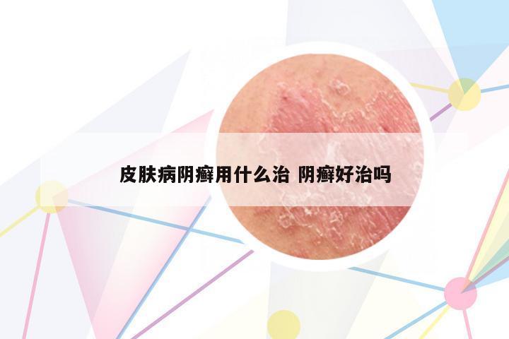 皮膚病陰癬用什么治 陰癬好治嗎